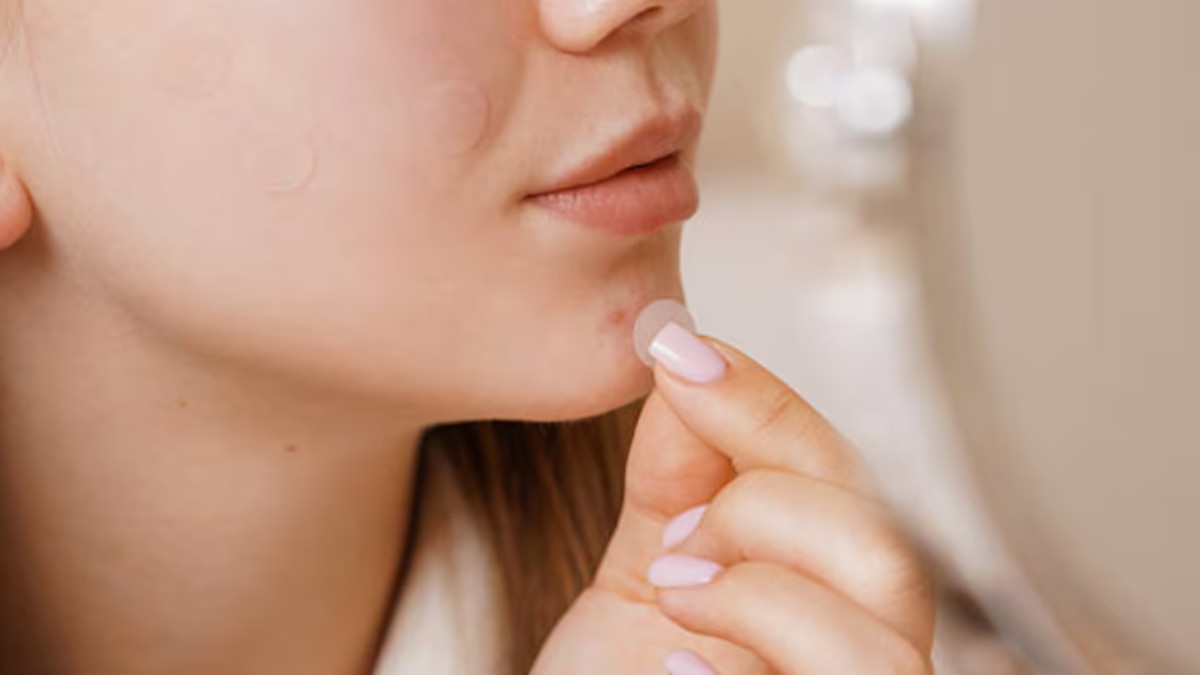 Qué son y para quiénes sí o no sirven los parches de acné